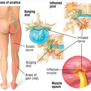 Sciatic Never Treatment - Sciatica ... The Incredible Discovery