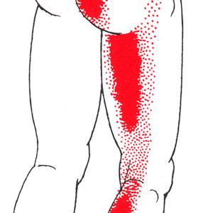 Herniated Discs 