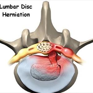 Sciatic Numbness In Foot - Sciatica Home Treatment