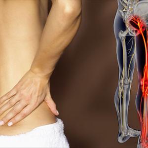 Sciatic Nerve Neuropathy Pictures - All About Sciatica
