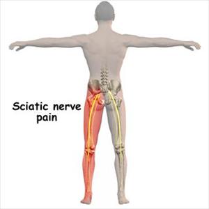 Sciatica Nerve Symptoms - Stop Your Sciatica ... Now!