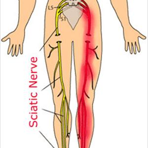 Causes Of Sciatic Nerve Pain - Referred Pain From The Lumbar Spine?