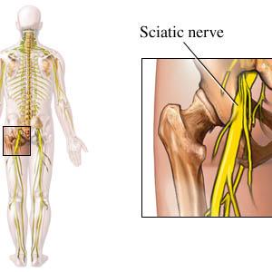 Sciatic Nerve Knee Pain - What Is Sciatica