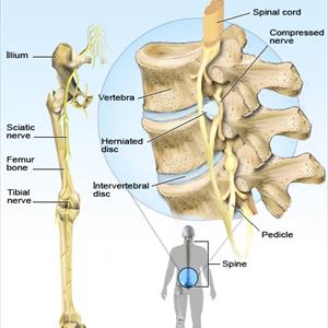 Sciatic Nerve Mri - Different Type Of Exercises