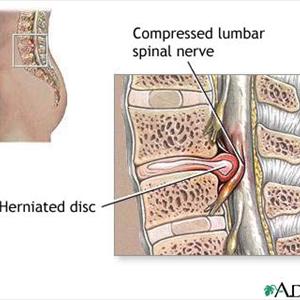 Sciatic Injury Recovery - Natural Treatment For Sciatica