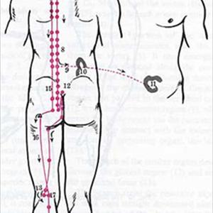 Sciatic Joint Fusion 