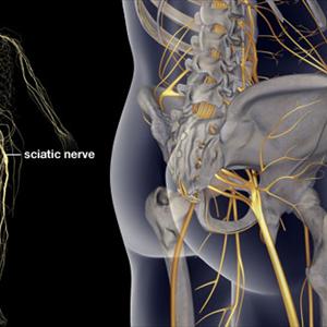 Sciatica Surgery 