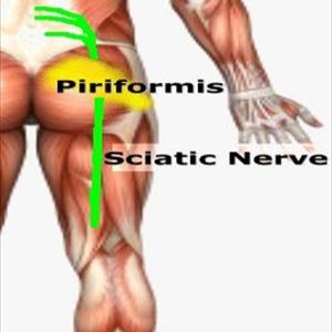 Herniated Disc L5 S1 - Sciatica - The Cause And The Cure