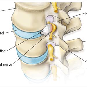 Sciatic Massage - What Are The 3 Best Exercises For Sciatica?