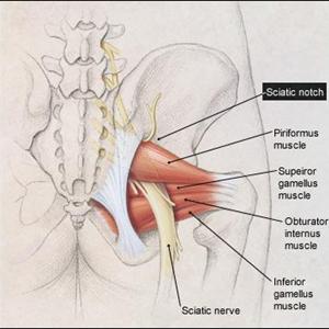 Bilateral Sciatica 