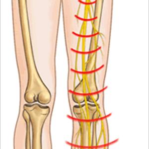 Sciatic Nerve Hip Pain - Sciatica & Spinal Research Institute @ Dr Kranthi For All Ur Spinal Problems