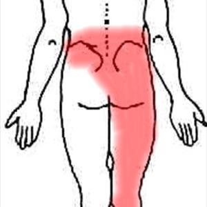 Sciatica Diagrams - Natural Sciataca Relief