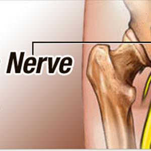 Pinched Sciatic Nerve Symptoms - Sciatica ... The Forgotten Cause