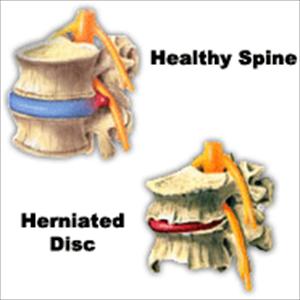 Information Symptoms Bilateral Sciatica 