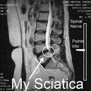 Sciatica Herbal Treatment - Exercises  For Sciatica