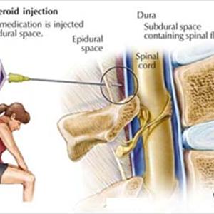 Sciatica Syndrome 