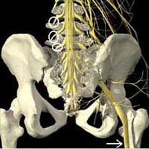 Sciatic Nerve Running - Sciatica: Cause And Diagnosis