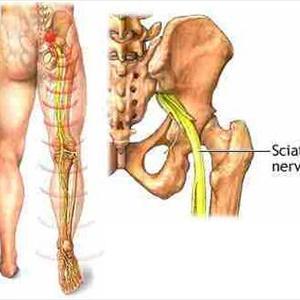 Frog Sciatic Nerve Anatomy - Sciatica & Spinal Research Institute @ Dr Kranthi For All Ur Spinal Problems