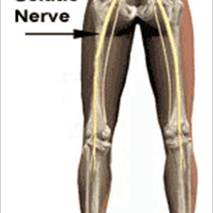 Stretching Exercises For Sciatic Pain - Pinched Nerve Pain Causes And Relief With The Drx9000 Spinal Decompression System