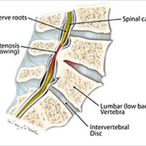 Sciatica Back Brace 