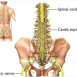 Acute Sciatica Pain - Sciatica Pain - Causes And Symptoms